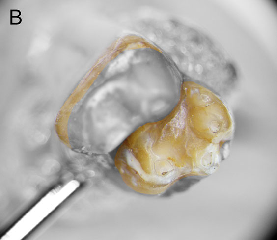 middle in-focus slice of tooth