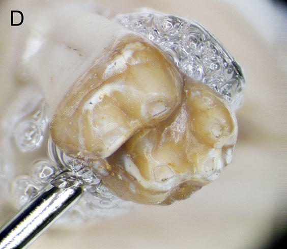 final stacked image of the tooth